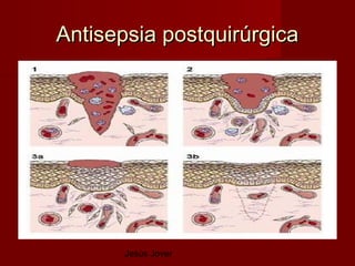 Antisepsia postquirúrgica




       Jesús Jover
 