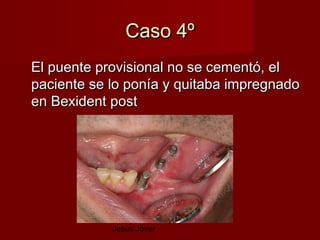 Caso 4º
El puente provisional no se cementó, el
paciente se lo ponía y quitaba impregnado
en Bexident post




            Jesús Jover
 