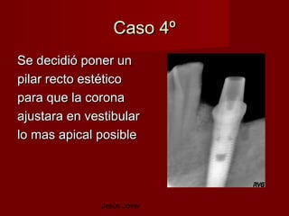 Caso 4º
Se decidió poner un
pilar recto estético
para que la corona
ajustara en vestibular
lo mas apical posible




               Jesús Jover
 