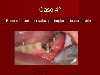 Caso 4º
Parece haber una salud perimplantaria aceptable




                Jesús Jover
 
