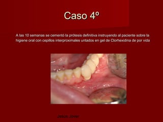 Caso 4º
A las 10 semanas se cementó la prótesis definitiva instruyendo al paciente sobre la
higiene oral con cepillos interproximales untados en gel de Clorhexidina de por vida




                         Jesús Jover
 