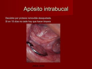 Apósito intrabucal
Decúbito por protesis removible desajustada.
Si en 15 días no cede hay que hacer biopsia




                         Jesús Jover
 