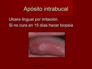 Apósito intrabucal
Ulcera lingual por irritación.
Si no cura en 15 días hacer biopsia




            Jesús Jover
 