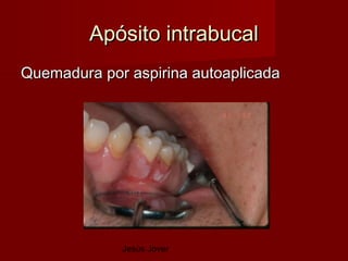 Apósito intrabucal
Quemadura por aspirina autoaplicada




             Jesús Jover
 