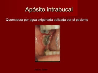 Apósito intrabucal
Quemadura por agua oxigenada aplicada por el paciente




                  Jesús Jover
 