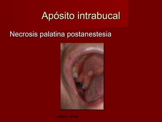 Apósito intrabucal
Necrosis palatina postanestesia




              Jesús Jover
 