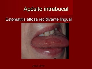 Apósito intrabucal
Estomatitis aftosa recidivante lingual




               Jesús Jover
 