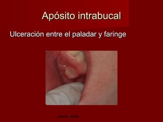 Apósito intrabucal
Ulceración entre el paladar y faringe




               Jesús Jover
 