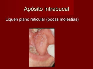 Apósito intrabucal
Liquen plano reticular (pocas molestias)




              Jesús Jover
 