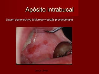 Apósito intrabucal
Liquen plano erosivo (doloroso y quizás precanceroso)




                      Jesús Jover
 