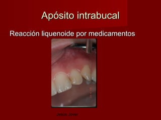 Apósito intrabucal
Reacción liquenoide por medicamentos




             Jesús Jover
 