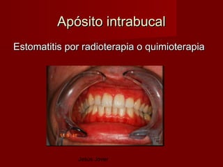 Apósito intrabucal
Estomatitis por radioterapia o quimioterapia




              Jesús Jover
 