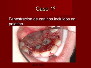 Caso 1º
Fenestración de caninos incluidos en
palatino.




            Jesús Jover
 
