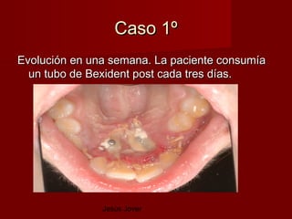 Caso 1º
Evolución en una semana. La paciente consumía
  un tubo de Bexident post cada tres días.




               Jesús Jover
 