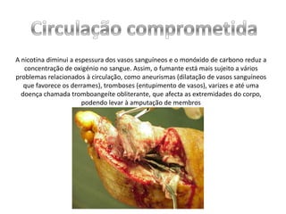 A nicotina diminui a espessura dos vasos sanguíneos e o monóxido de carbono reduz a
concentração de oxigénio no sangue. Assim, o fumante está mais sujeito a vários
problemas relacionados à circulação, como aneurismas (dilatação de vasos sanguíneos
que favorece os derrames), tromboses (entupimento de vasos), varizes e até uma
doença chamada tromboangeíte obliterante, que afecta as extremidades do corpo,
podendo levar à amputação de membros

 