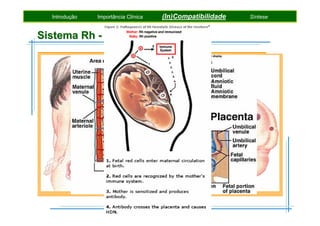 Introdução

Importância Clínica

(In)Compatibilidade

Síntese

Sistema Rh - correlações clínicas
• Isoimunização / Eritroblastose Fetal / Doença Hemolítica do RN
ocorre quando uma mãe Rh- se encontra grávida de uma
criança Rh+ (pai Rh+) e desenvolve anticorpos anti-D IgG
A mãe é sensibilizada numa gravidez anterior ou numa
transfusão de sangue, sendo nessa altura a quantidade de
anticorpos insuficiente para provocar doença clínica
Quando novamente exposta gera-se uma intensa resposta
imunitária contra os eritrócitos do feto, causando anemia

 