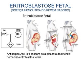ERITROBLASTOSE FETAL
(DOENÇA HEMOLÍTICA DO RECÉM NASCIDO)
Anticorpos Anti-RH passam pela placenta destruindo
hemácias/eritroblastos fetais.
 