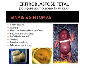 ERITROBLASTOSE FETAL
(DOENÇA HEMOLÍTICA DO RECÉM NASCIDO)
 