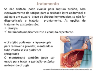 o cirurgião pode usar a laparoscopia
para remover a gravidez, mantendo a
tuba intacta se ela puder ser
recuperada
O metotrexato também pode ser
usado para tratar a gestação ectópica
no lugar da cirurgia
http://www.endometriosis.com.es/wp-content/uploads/2008/10/laparoscopia001.jpg
Se não tratada, pode evoluir para ruptura tubária, com
extravasamento de sangue para a cavidade intra-abdominal e
até para um quadro grave de choque hemorrágico, se não for
diagnosticada e tratada prontamente. As opções de
tratamento existentes são:
 cirurgia,
 tratamento medicamentoso e conduta expectante.
tratamento
 