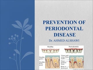 Dr. AHMED ALSHAWI
PREVENTION OF
PERIODONTAL
DISEASE
 