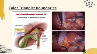 [GS] Cholecystectomy Talk Powerpoint presentation | PPTX