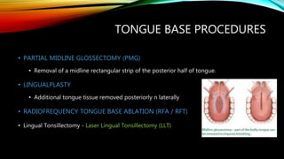TONGUE BASE PROCEDURES
• PARTIAL MIDLINE GLOSSECTOMY (PMG)
• Removal of a midline rectangular strip of the posterior half of tongue.
• LINGUALPLASTY
• Additional tongue tissue removed posteriorly n laterally
• RADIOFREQUENCY TONGUE BASE ABLATION (RFA / RFT)
• Lingual Tonsillectomy - Laser Lingual Tonsillectomy (LLT)
 
