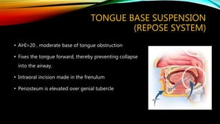 TONGUE BASE SUSPENSION
(REPOSE SYSTEM)
• AHI>20 , moderate base of tongue obstruction
• Fixes the tongue forward, thereby preventing collapse
into the airway.
• Intraoral incision made in the frenulum
• Periosteum is elevated over genial tubercle
 