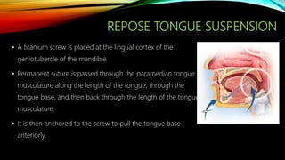 REPOSE TONGUE SUSPENSION
• A titanium screw is placed at the lingual cortex of the
geniotubercle of the mandible
• Permanent suture is passed through the paramedian tongue
musculature along the length of the tongue, through the
tongue base, and then back through the length of the tongue
musculature.
• It is then anchored to the screw to pull the tongue base
anteriorly.
 
