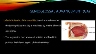 GENIOGLOSSAL ADVANCEMENT (GA)
• Genial tubercle of the mandible (anterior attachment of
the genioglossus muscle) is mobilized by means of limited
osteotomy.
• The segment is then advanced, rotated and fixed into
place at the inferior aspect of the osteotomy.
 