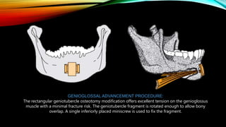 GENIOGLOSSAL ADVANCEMENT PROCEDURE:
The rectangular geniotubercle osteotomy modification offers excellent tension on the genioglossus
muscle with a minimal fracture risk. The geniotubercle fragment is rotated enough to allow bony
overlap. A single inferiorly placed miniscrew is used to fix the fragment.
 