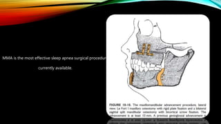 MMA is the most effective sleep apnea surgical procedure
currently available.
 