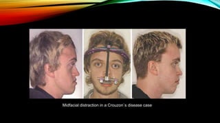 Midfacial distraction in a Crouzon`s disease case
 