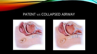 PATENT V/S COLLAPSED AIRWAY
 