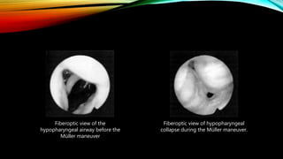 Fiberoptic view of the
hypopharyngeal airway before the
Müller maneuver
Fiberoptic view of hypopharyngeal
collapse during the Müller maneuver.
 