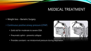 MEDICAL TREATMENT
• Weight loss – Bariatric Surgery
• Continuous positive airway pressure (CPAP)
• Gold std for moderate to severe OSA
• Pneumatic splint – prevents collapse
• Provides constant +ve intraluminal pressure during respiration.
 