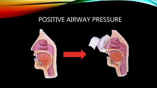 POSITIVE AIRWAY PRESSURE
 