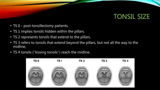 TONSIL SIZE
• TS 0 - post-tonsillectomy patients.
• TS 1 implies tonsils hidden within the pillars.
• TS 2 represents tonsils that extend to the pillars.
• TS 3 refers to tonsils that extend beyond the pillars, but not all the way to the
midline,
• TS 4 tonsils (‘‘kissing tonsils’’) reach the midline.
 