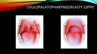 UVULOPALATOPHARYNGOPLASTY (UPPP)
 
