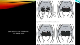 Semi-elliptical soft palate with a
functioning uvula.
 