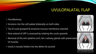 UVULOPALATAL FLAP
• Tonsillectomy.
• Incisions into the soft palate bilaterally on both sides.
• Tip of uvula grasped & excessive mucous membrane resected.
• Now extend of UPF is assessed by rotating the uvula upwards.
• Removal of the antr palatine arch, fat n salivary glands with preservation
of muscles
• Uvula is loosely folded into the defect & sutured
 