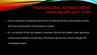 TRANSPALATAL ADVANCEMENT
PHARYNGOPLASTY (TAP)
• Aims to decrease retropalatal obstruction by altering the bony hard palate and the
soft tissue attachments of the posterior maxilla.
• A 1-cm portion of the hard palate is removed, and the soft palate is then advanced
and secured medially and laterally in the tensor aponeurosis, which enlarges the
retropalatal region.
 