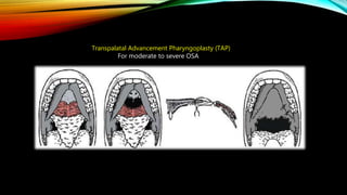 Transpalatal Advancement Pharyngoplasty (TAP)
For moderate to severe OSA
 