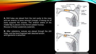 A, Drill holes are placed from the oral cavity to the nose
and are anterior to bone removal (orange). A strong rim of
bone supports the sutures. The anterior extent of the
middle flap is placed in the thinner palatal mucosa.
Mucosa is thicker posteriorly (asterisk).
B, After osteotomy, sutures are placed through the drill
holes, and the bone fragment with attached tendon
and ligaments is advanced.
 
