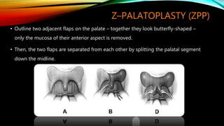 Z–PALATOPLASTY (ZPP)
• Outline two adjacent flaps on the palate – together they look butterfly-shaped –
only the mucosa of their anterior aspect is removed.
• Then, the two flaps are separated from each other by splitting the palatal segment
down the midline.
 