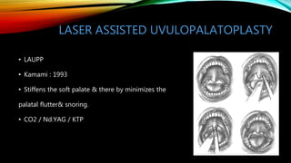 LASER ASSISTED UVULOPALATOPLASTY
• LAUPP
• Kamami : 1993
• Stiffens the soft palate & there by minimizes the
palatal flutter& snoring.
• CO2 / Nd:YAG / KTP
 