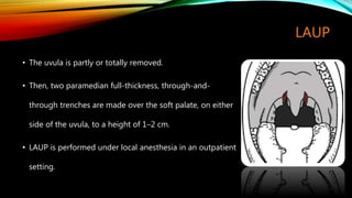 LAUP
• The uvula is partly or totally removed.
• Then, two paramedian full-thickness, through-and-
through trenches are made over the soft palate, on either
side of the uvula, to a height of 1–2 cm.
• LAUP is performed under local anesthesia in an outpatient
setting.
 