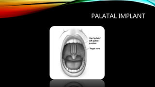 PALATAL IMPLANT
 