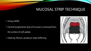 MUCOSAL STRIP TECHNIQUE
• Using LASER
• Central longitudinal strip of mucosa is removed from
the surface of soft palate.
• Heals by fibrosis, produces reqd stiffening.
 