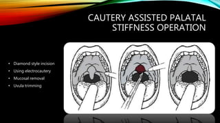 CAUTERY ASSISTED PALATAL
STIFFNESS OPERATION
• Diamond style incision
• Using electrocautery
• Mucosal removal
• Uvula trimming
 