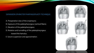 A. Preoperative view of the oropharynx.
B. Exposure of the palatopharyngeus (vertical fibers).
C. Elevation of the palatopharyngeus.
D. Rotation and tunnelling of the palatopharyngeus
toward the hamulus.
E. Suture suspension and approximation.
EXPANSION SPHINCTER PHARYNGOPLASTY TECHNIQUE.
 